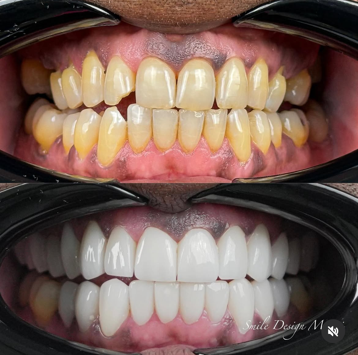 Teeth Whitening Options: What Works Best?