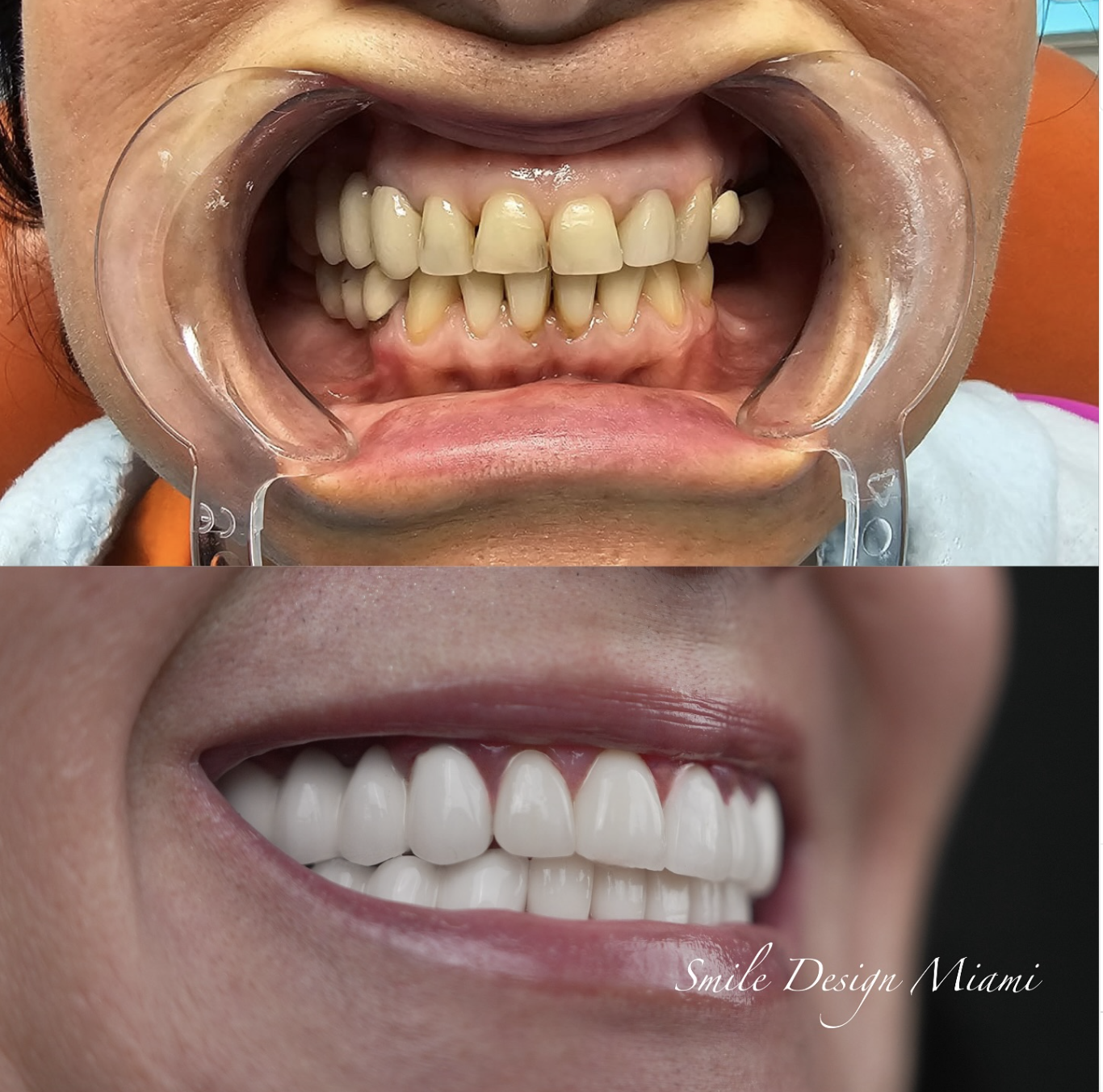 Veneer Procedure Explained