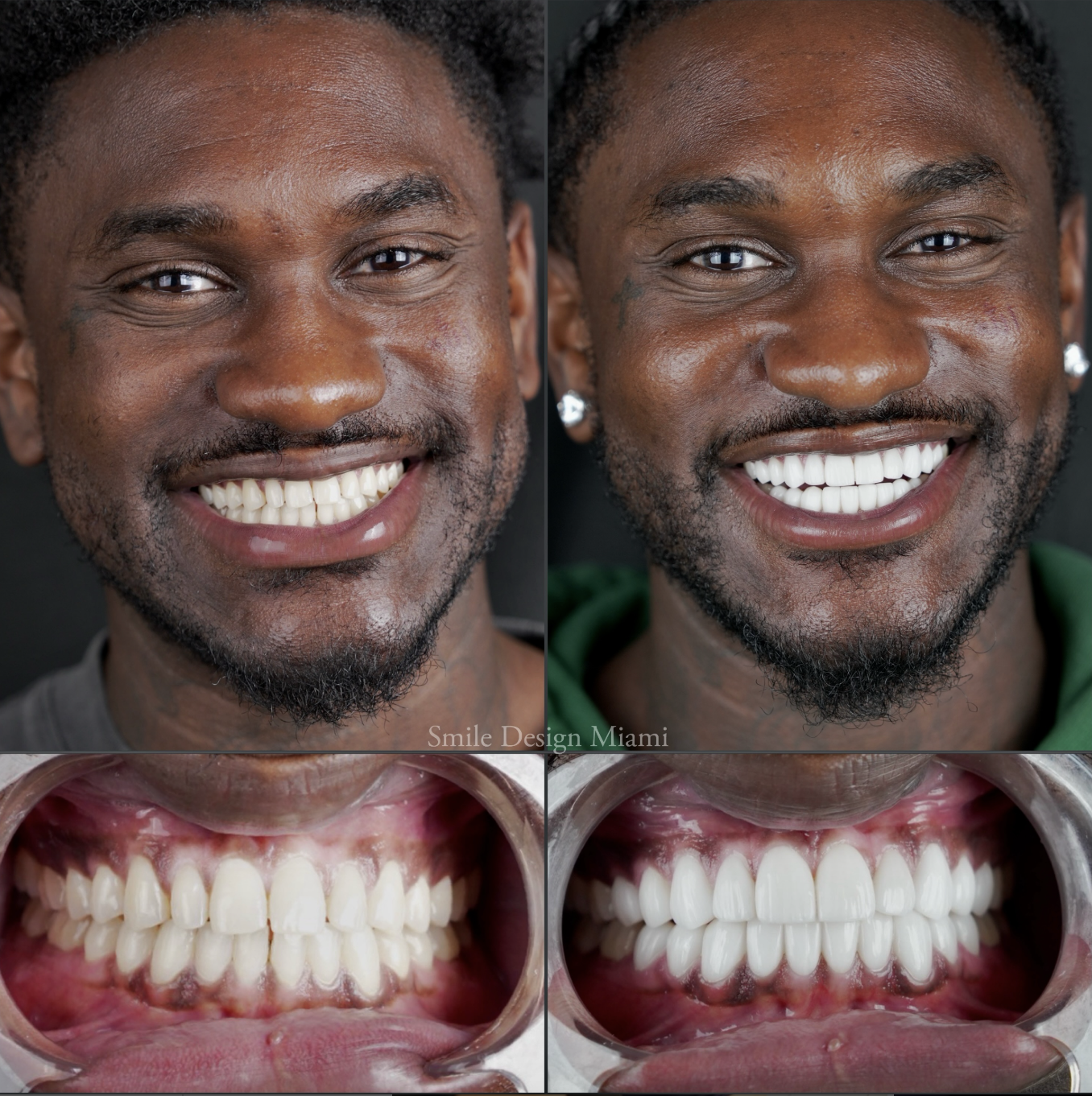 Teeth Whitening