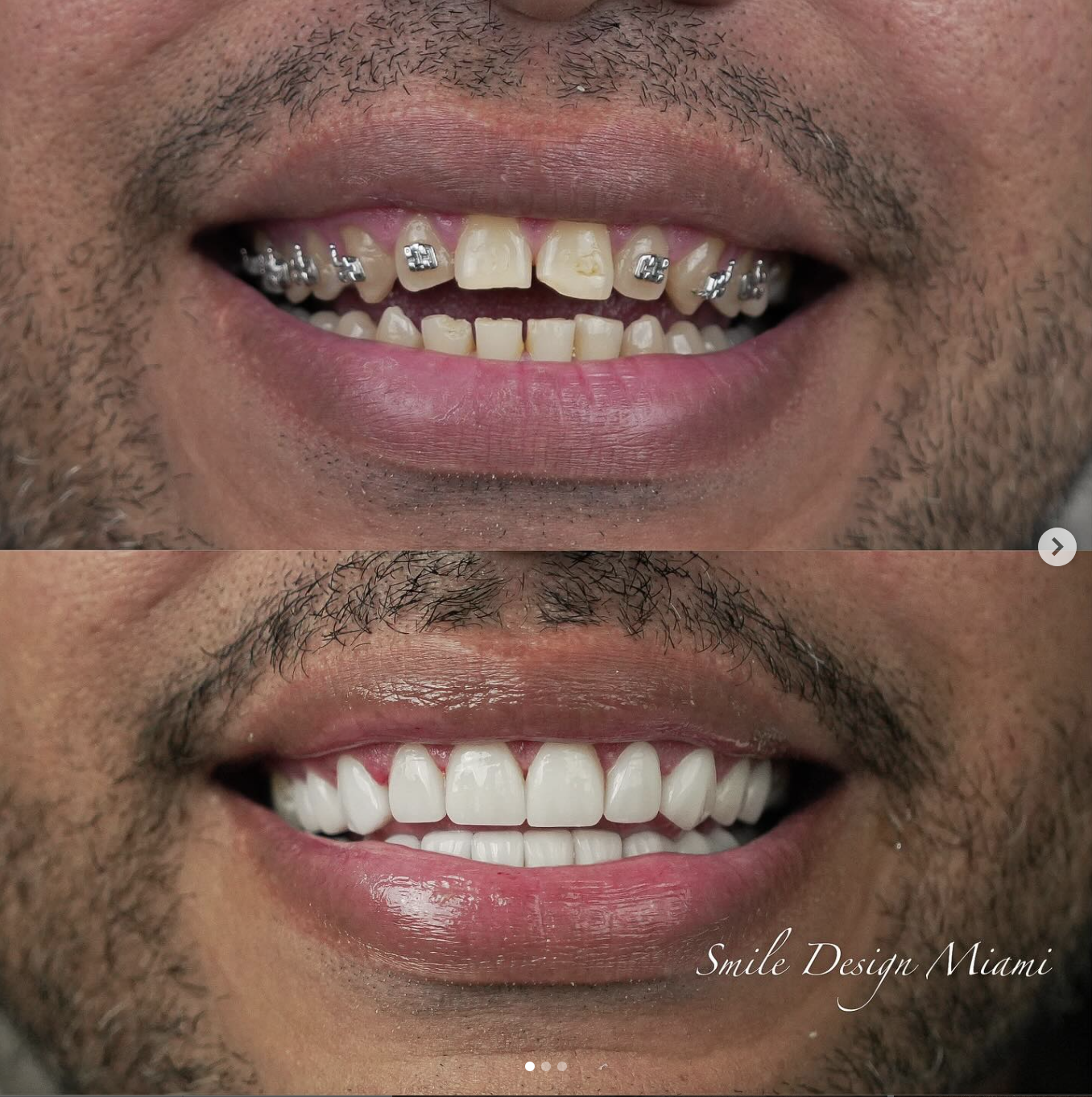 Orthodontic Braces