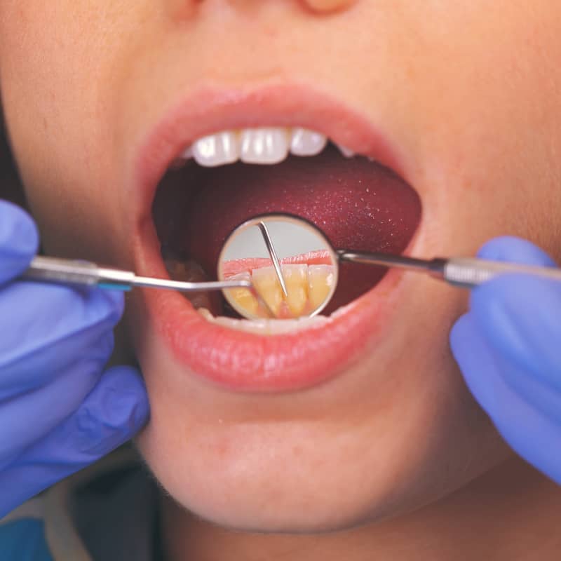 Smile Makeover
