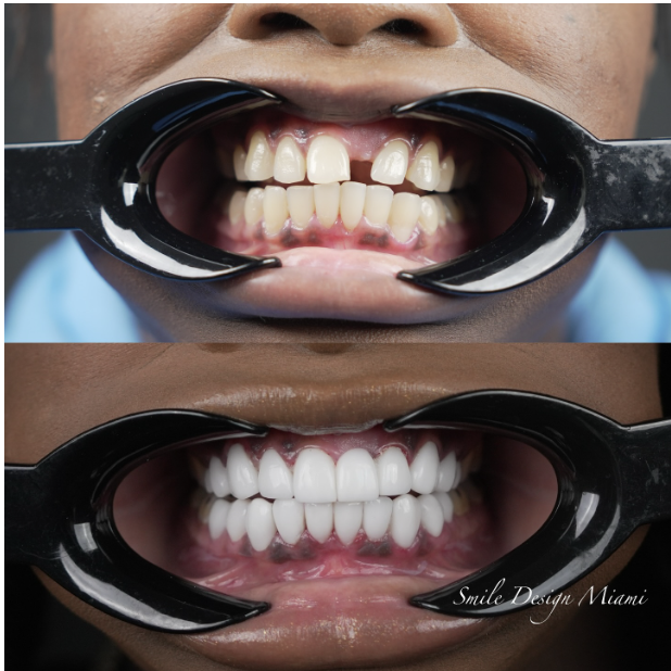 Dental Implants