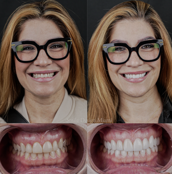 Teeth Cleaning